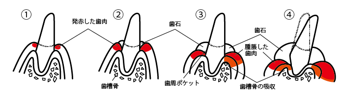 歯周病の進行過程